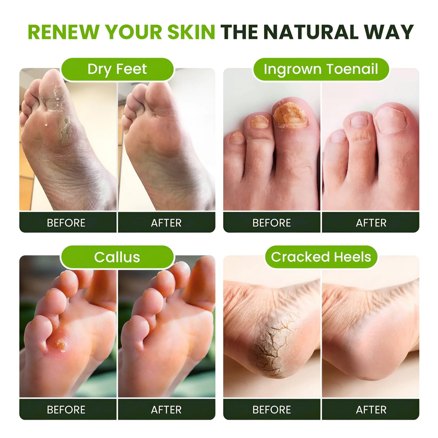 FOOT CURE Tea Tree Oil Foot Soak with Epsom Salts- for Foot Pain, Soreness, Athletes Foot, Odors, Toe Nail Fungus, Fungal, Calluses (Pack of 4)