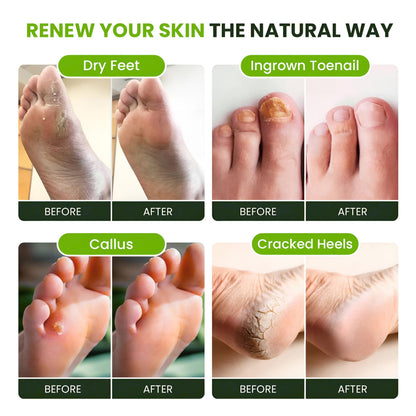 FOOT CURE Tea Tree Oil Foot Soak with Epsom Salts- for Foot Pain, Soreness, Athletes Foot, Odors, Toe Nail Fungus, Fungal, Calluses (Pack of 4)