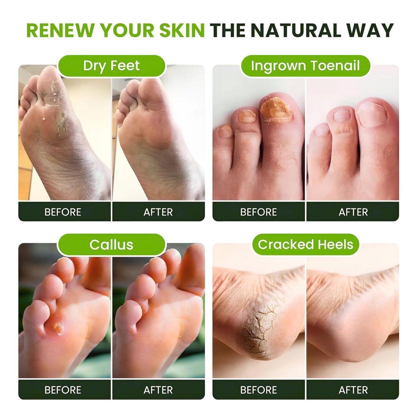 FOOT CURE Tea Tree Oil Foot Soak with Epsom Salts- for Foot Pain, Soreness, Athletes Foot, Odors, Toe Nail Fungus, Fungal, Calluses (Pack of 4)